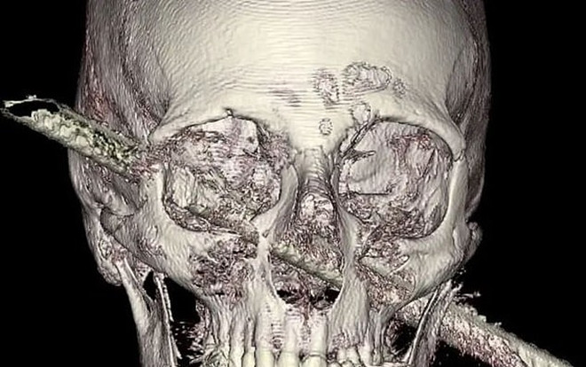 Bị thanh sắt xuyên qua đầu, người đàn ông nói 'không đau đớn gì' Ảnh 2