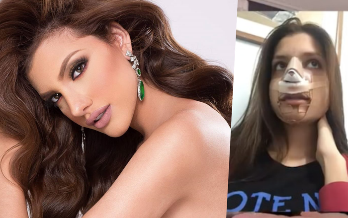 Hoa hậu Hoà bình Quốc tế 2019 công khai phẫu thuật thẩm mỹ: Gắn ốc vít vào miệng, gọt xương hàm Ảnh 2