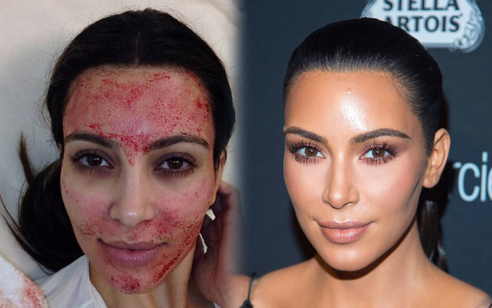 Những cách làm đẹp kì dị của siêu sao: Người cho ong đốt lên mặt, người đắp phân chim Ảnh 2