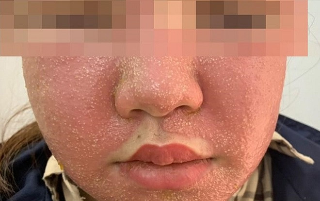 Mua mặt nạ làm trắng da trên mạng sử dụng, cô gái bị sưng phù mặt, nổi mụn mủ chi chít Ảnh 2