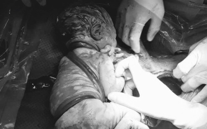 Bé trai chào đời thành công với 6 vòng dây rốn quấn chặt quanh người Ảnh 2