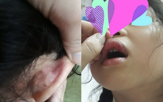 Phụ huynh tố giáo viên chủ nhiệm tát chảy máu, dập môi con gái học lớp 2 vì làm sai bài Toán Ảnh 2