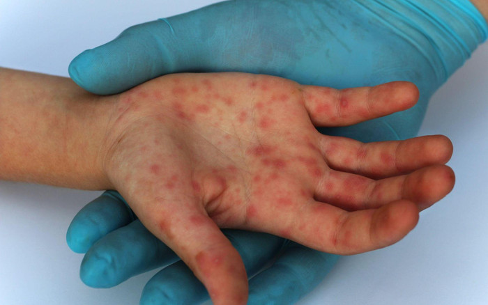 TP.HCM ghi nhận 19 ca bệnh đậu mùa khỉ Ảnh 2