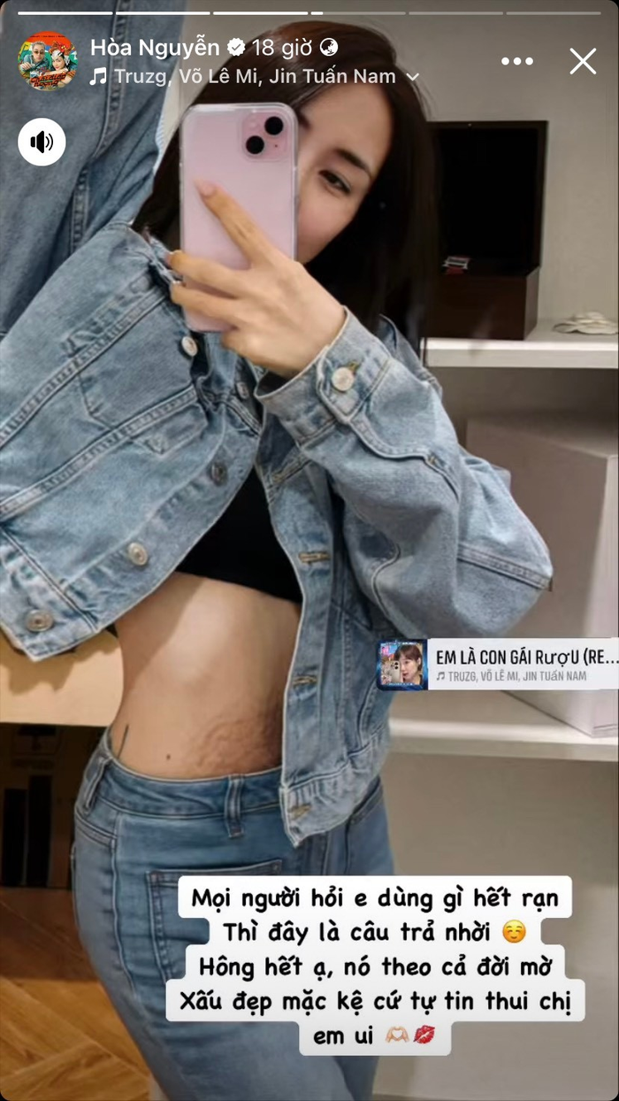 Trước đó Hoà Minzy từng nhiều lần chia sẻ về việc bản thân bị rạn bụng trong quá trình mang thai, sinh nở bé Bo