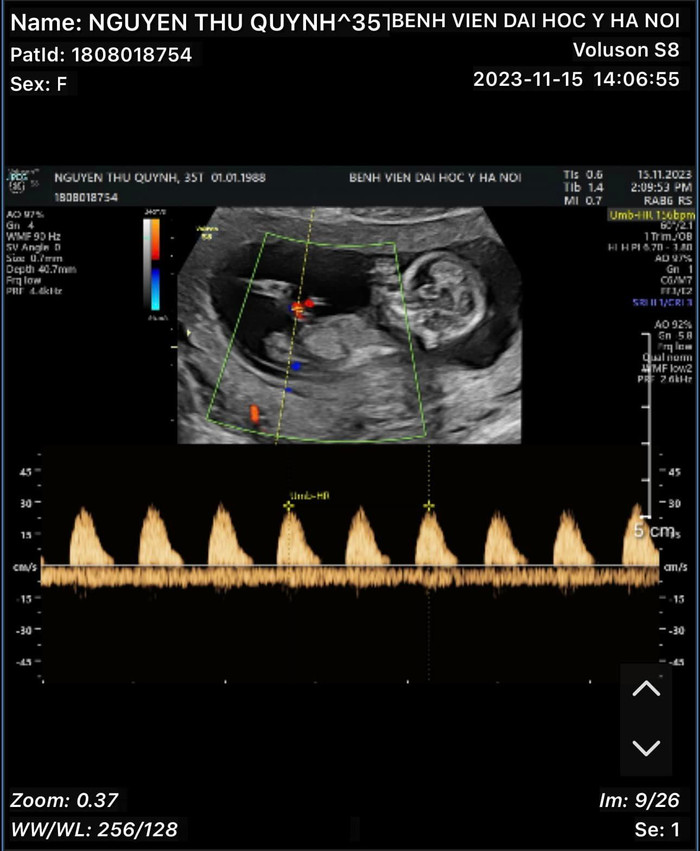 Hình ảnh siêu âm thai của Thu Quỳnh