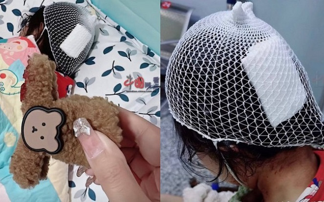 Dùng kẹp tóc càng cua, bé gái trả giá đắt không ngờ Ảnh 2