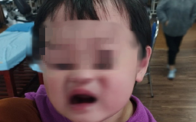 Bé gái 2 tuổi bị méo miệng sau khi được bố mẹ chở đi chơi vào tối muộn Ảnh 2