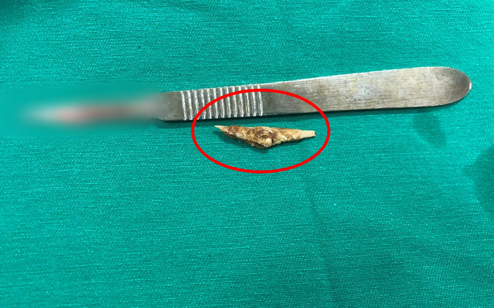 Đau bụng nhiều năm, người đàn ông đi khám phát hiện thứ kinh hãi trong bụng Ảnh 2