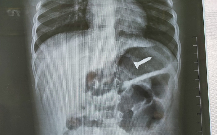 Bé 3 tuổi nuốt nhập viện khẩn vì nuốt nhầm thứ đồ nhà nào cũng có, bác sĩ cảnh báo cực kỳ nguy hiểm Ảnh 2