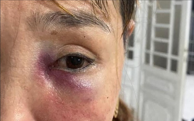 Đang đứng bếp, nữ chủ quán mì Quảng bị khách nam đánh bầm mặt Ảnh 2