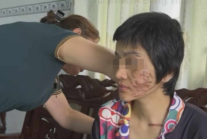 Trên mặt chị G. chằng chịt vết thương. (Ảnh: VietNamNet) 