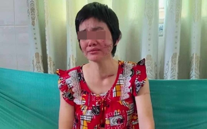 Công an vào cuộc vụ người phụ nữ tố chồng đánh bị thương chằng chịt khắp cơ thể Ảnh 2