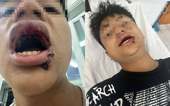 Nam sinh 14 tuổi bị đánh gãy răng, rách môi khi đi tắm biển ở Đà Nẵng Ảnh 2