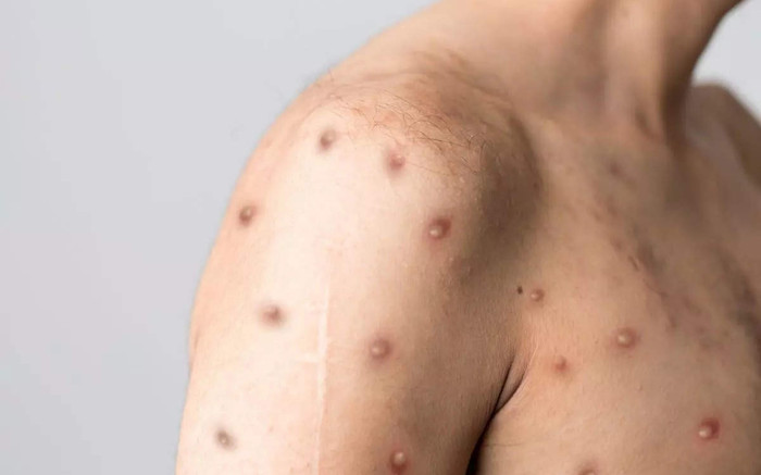 Lây thủy đậu từ con trai, ông bố trẻ tuổi tử vong thương tâm Ảnh 2