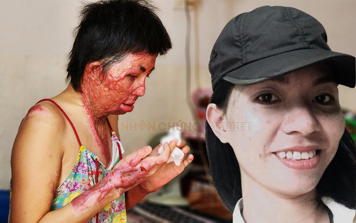 Bi kịch người phụ nữ bị chồng thiêu sống: Đau đớn đến mức ước chết, được tiếng hát của con 'cứu sống' Ảnh 2