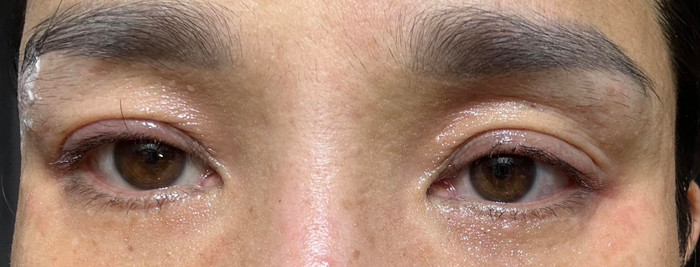 Hình ảnh đôi mắt sưng tấy của nữ MC sau buổi diễn phúc khảo đã khiến nhiều khán giả xót xa. Được biết MC Cát Tường dị ứng với các loại keo dán lông mi giả 3 năm gần đây.