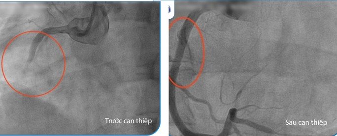 Mạch vành của bệnh nhân trước và sau khi đặt stent.