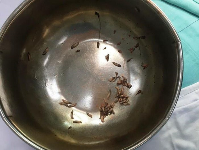  Người đàn ông được phát hiện hàng chục con ký sinh ngoe nguẩy trong khí quản Ảnh 1