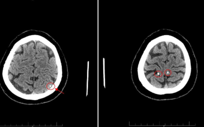 Não người đàn ông bị tàn phá vì thường xuyên ăn món phổ biến tưởng như vô hại Ảnh 2