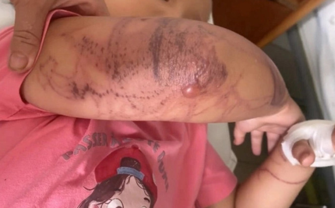 Bé gái đi tắm biển bị sứa đốt đến mất ý thức, 2 cánh tay chằng chịt vết thương Ảnh 2