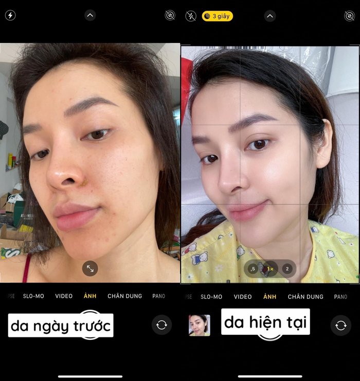 Cô nàng cho biết, cách làm đẹp mà mình sử dụng trong lúc mang thai là peel da (thay da sinh học) bằng các hoạt chất. 