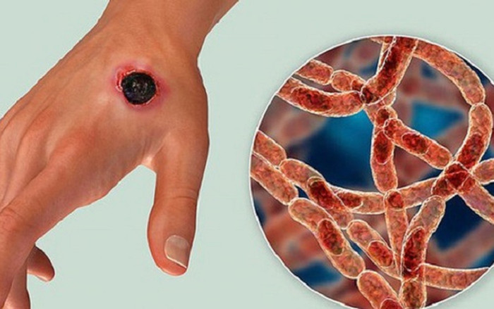 Phát hiện nhiều ổ dịch bệnh than trên người ở Điện Biên Ảnh 2