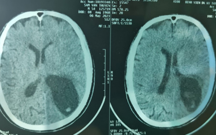 Phát hiện thứ kinh hoàng ký sinh trong vùng não của người đàn ông ở Nghệ An Ảnh 2