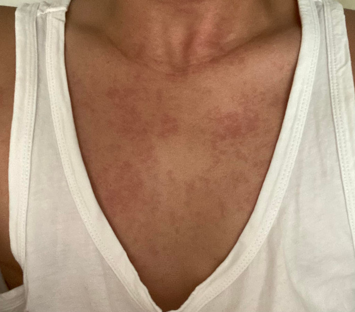 Mẩn đỏ trên người của Kenji