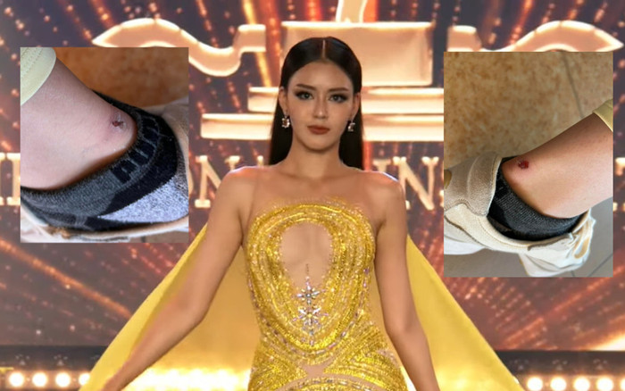 Đại diện Việt Nam tại Miss Supranational gặp sự cố, xót xa cho đôi chân sưng vù! Ảnh 2