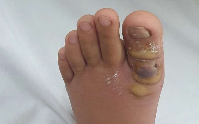 Sau khi nhổ sợi lông chân, thiếu nữ sốt cao phải tức tốc nhập viện Ảnh 2