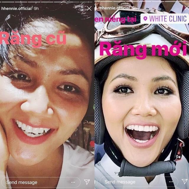 Khác với Khánh Vân, Tiểu Vy, nàng Hậu ưu ái chọn lựa phương pháp niềng răng không mắc cài (Invisalign) với những khay niềng trong suốt khó có thể nhận ra. Người đẹp Đắk Lắk chia sẻ: “Khi Hen sử dụng loại niềng răng này hầu như rất ít người nhận ra Hen đang có đeo niềng răng luôn đó”.