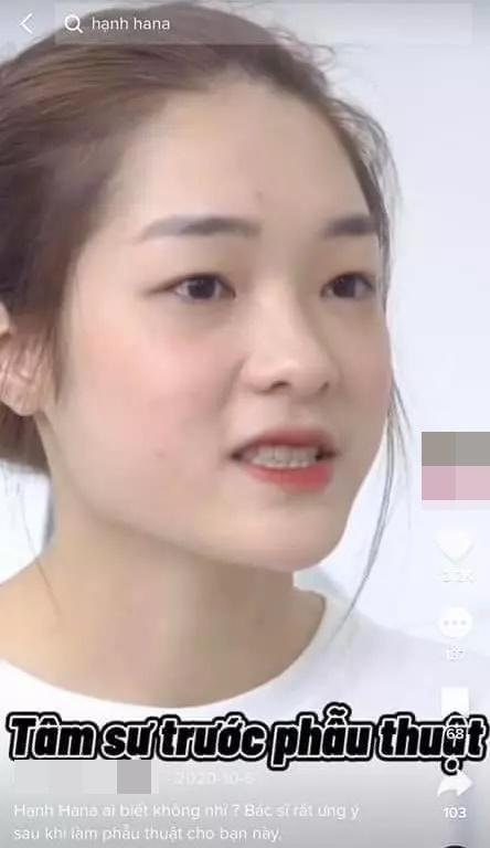 Bên cạnh visual lung linh, câu chuyện của mỹ nhân này được mọi người quan tâm hết mực. Do, cô đã 'đập đi xây lại' toàn bộ gương mặt để cải thiện bề ngoài. Hình ảnh trên là nhan sắc nguyên bản của Hồng Hạnh.
