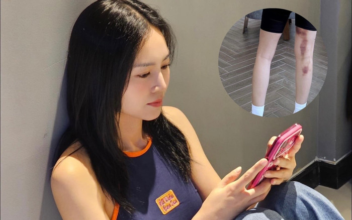 Ninh Dương Lan Ngọc để lộ vết bầm lớn trên cơ thể khiến fan lo lắng Ảnh 2