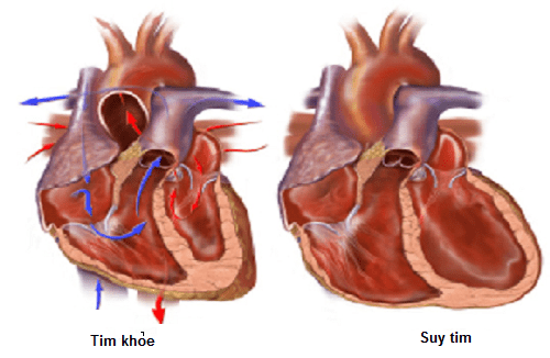 Qua đời vì viêm phổi dẫn đến suy tim, bệnh của Phương Anh nguy hiểm thế nào? Ảnh 2