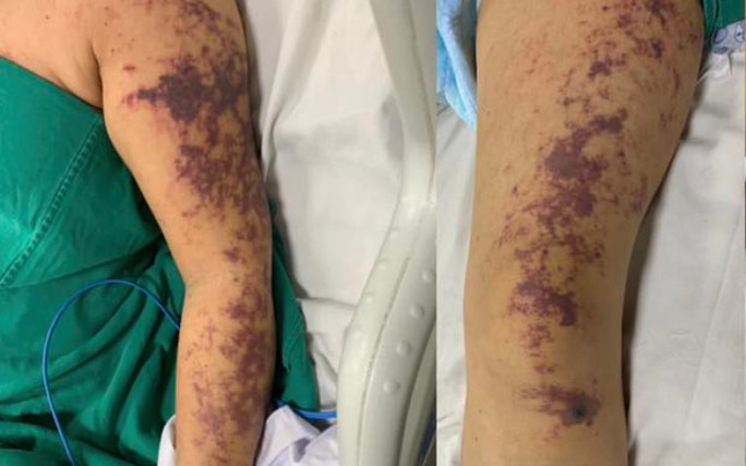 Sau khi ăn lòng lợn, người phụ nữ nhập viện trong tình trạng nguy kịch Ảnh 2