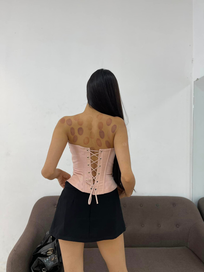 Phía sau lưng người đẹp xuất hiện chằng chịt những vết giác hơi dày đặc.