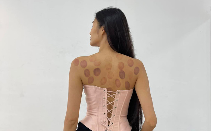 Hoàng Thùy lộ rõ sức khoẻ đáng lo, lưng chẳng chịt vết bầm đỏ Ảnh 2