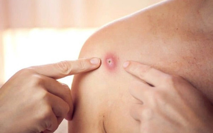 TP.HCM phát hiện 8 người tiếp xúc gần với ca mắc đậu mùa khỉ Ảnh 2