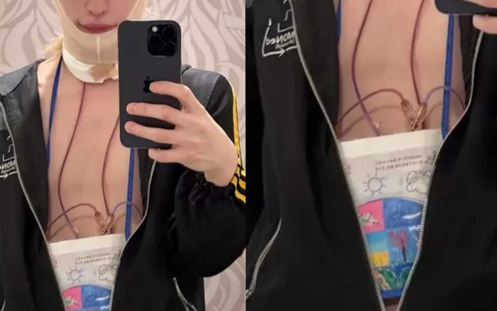 Nam ca sĩ 32 tuổi công khai ảnh phẫu thuật thẩm mỹ khiến dân tình xôn xao Ảnh 2