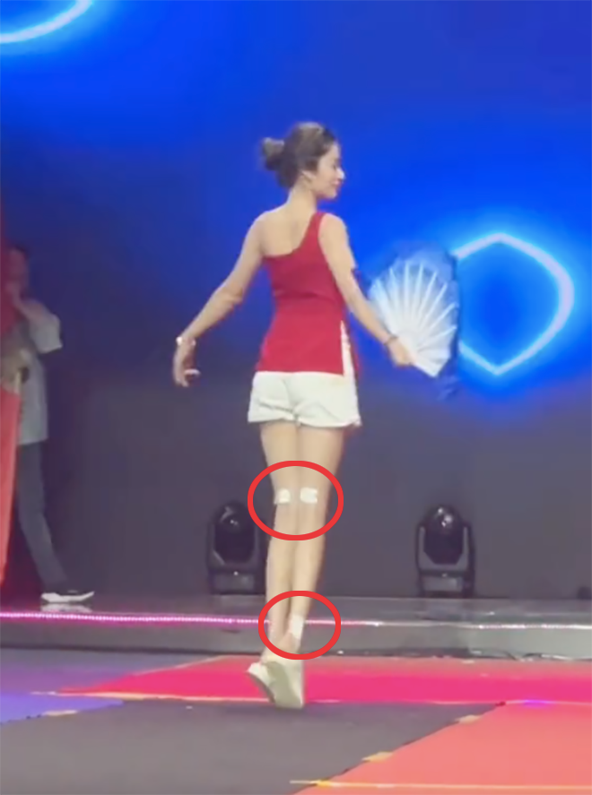 Những miếng dán khắp chân của Lệ Nam.