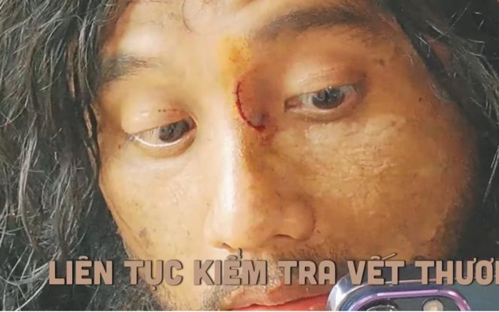 Cận cảnh chiếc mũi bị rách của Mai Tài Phến.