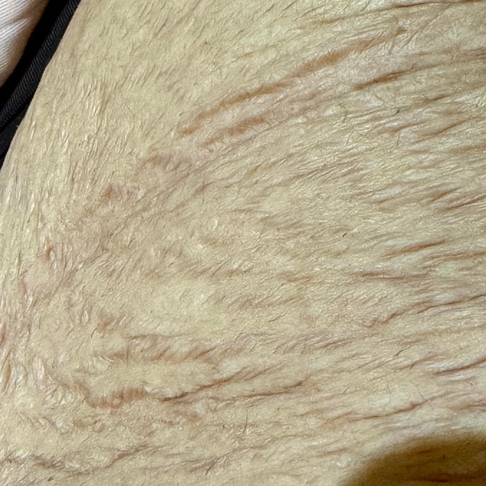 Hiện tại trên cơ thể Hoà Minzy vẫn còn nhiều vết rạn