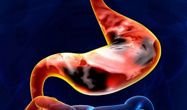 Ung thư dạ dày giai đoạn cuối. (Ảnh minh họa) 