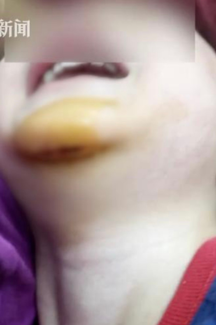 Vết thương ở dưới cằm của cháu bé. Ảnh: Sina