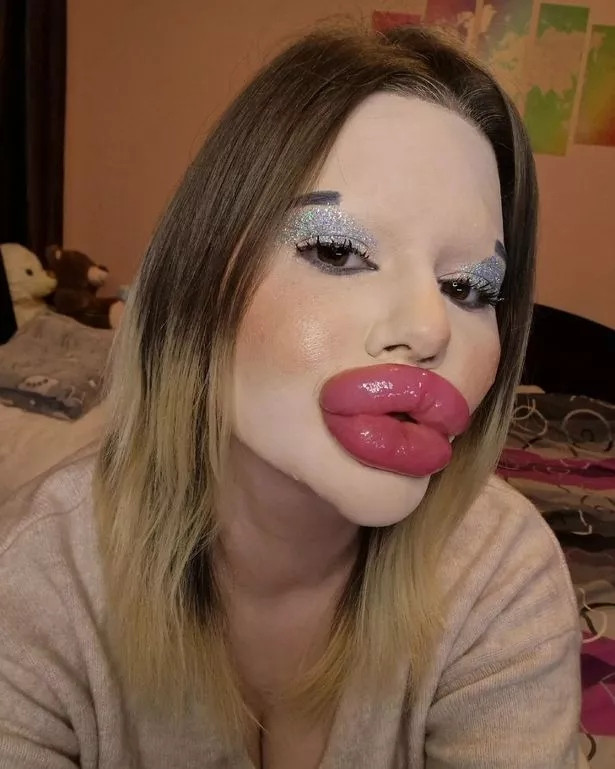 Lạm dụng việc tiêm filler môi có thể dẫn đến nhiều rủi ro.