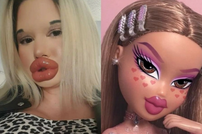 Đôi môi sau khi hơn 9.000 USD cho 32 lần tiêm filler.