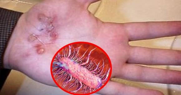 Whitmore có thể xâm nhập qua đường trầy xước.