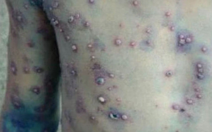 Xuất hiện ổ dịch thủy đậu tại Đắk Lắk Ảnh 2