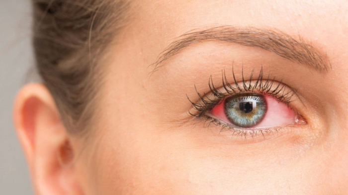 Đeo lens không đúng cách đem lại nhiều tác hại cho mắt.