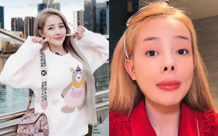 Bộ phận bị biến chứng co rút trên gương mặt của Ngân 98 Ảnh 2